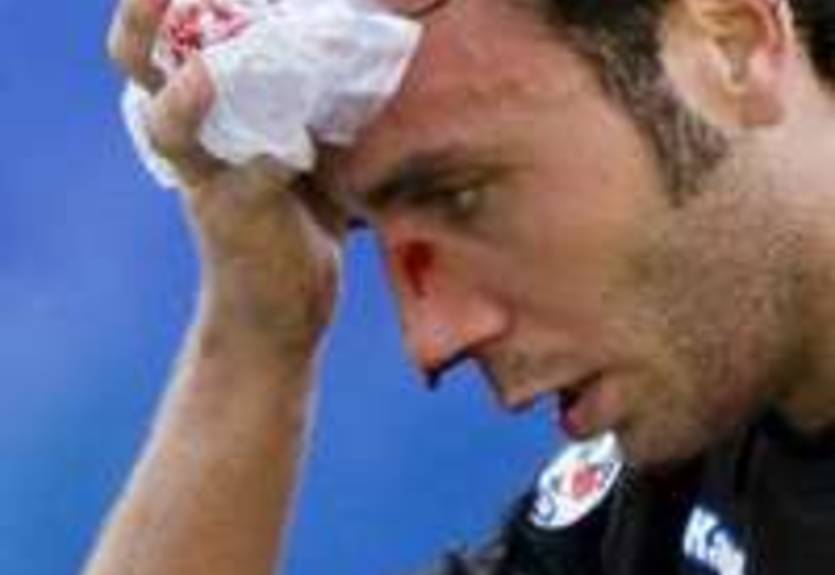 У Паццини перелом носа